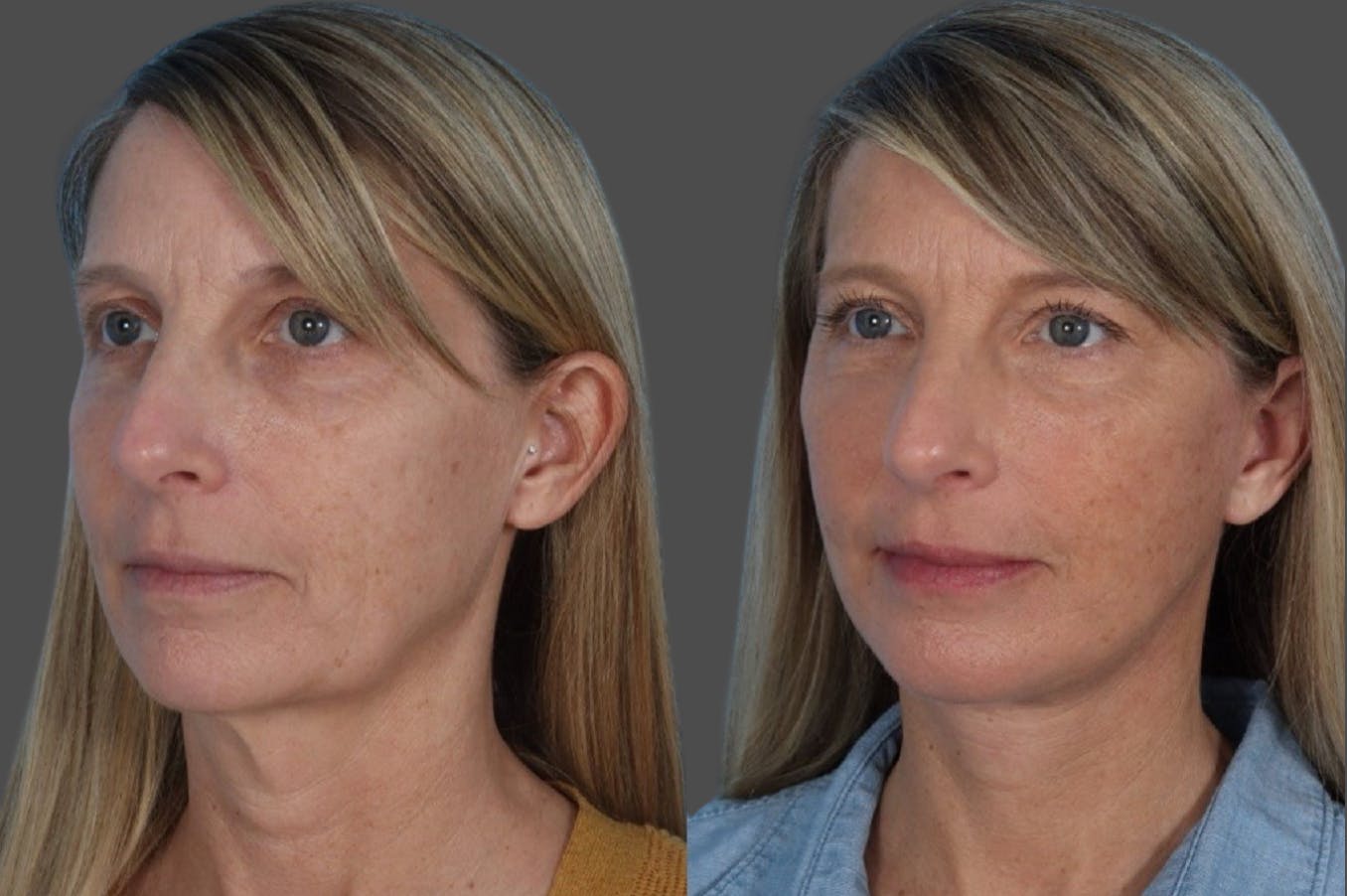 Microliposuction Before & After Gallery - Patient 273120 - Image 2