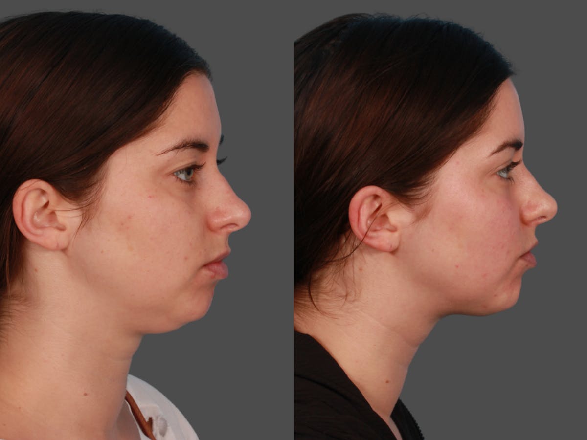 Microliposuction  Before & After Gallery - Patient 375684 - Image 3