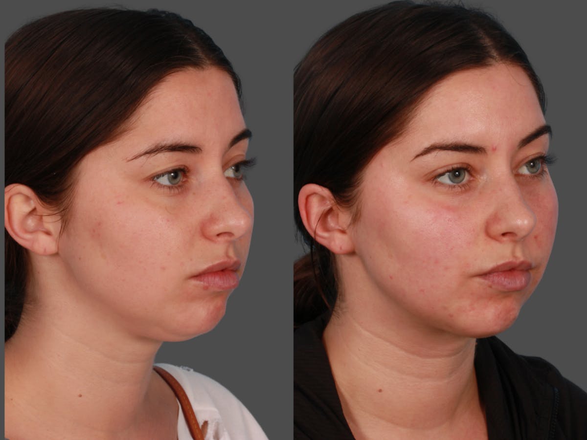 Microliposuction  Before & After Gallery - Patient 375684 - Image 2