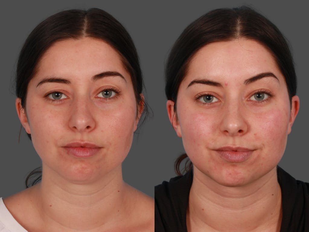 Microliposuction Before & After Gallery - Patient 375684 - Image 1