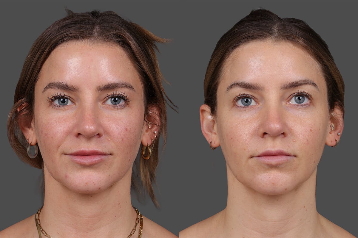 Moxi Before & After Gallery - Patient 530192 - Image 1