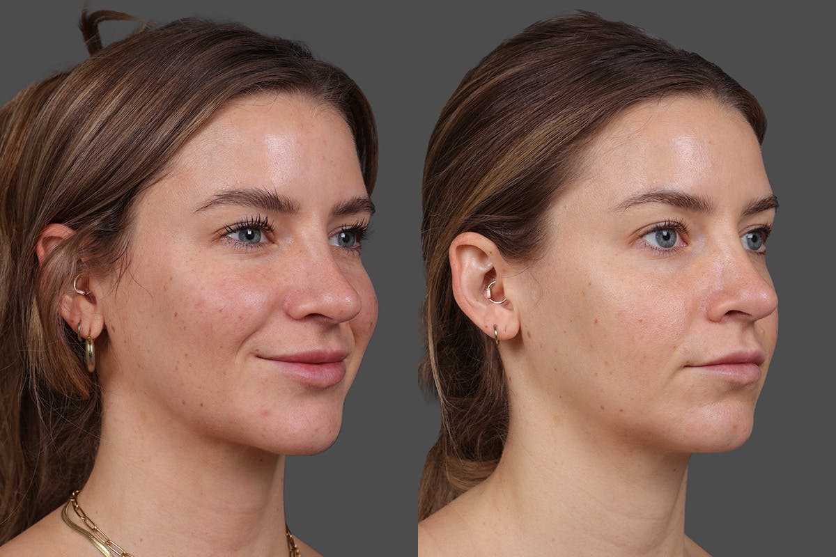 Moxi Before & After Gallery - Patient 530192 - Image 2