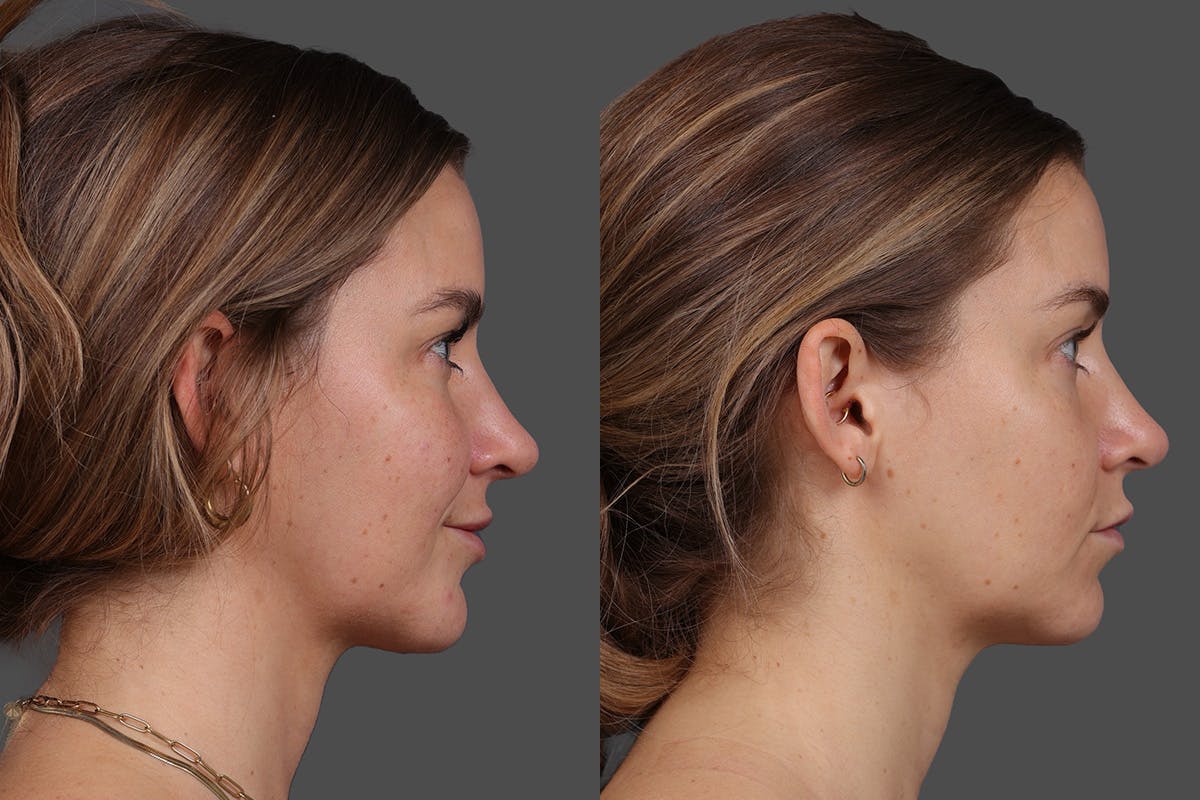 Moxi Before & After Gallery - Patient 530192 - Image 3