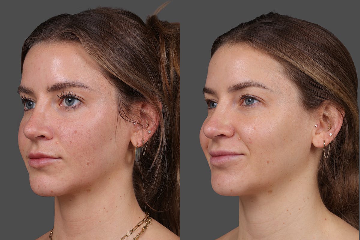 Moxi Before & After Gallery - Patient 530192 - Image 4
