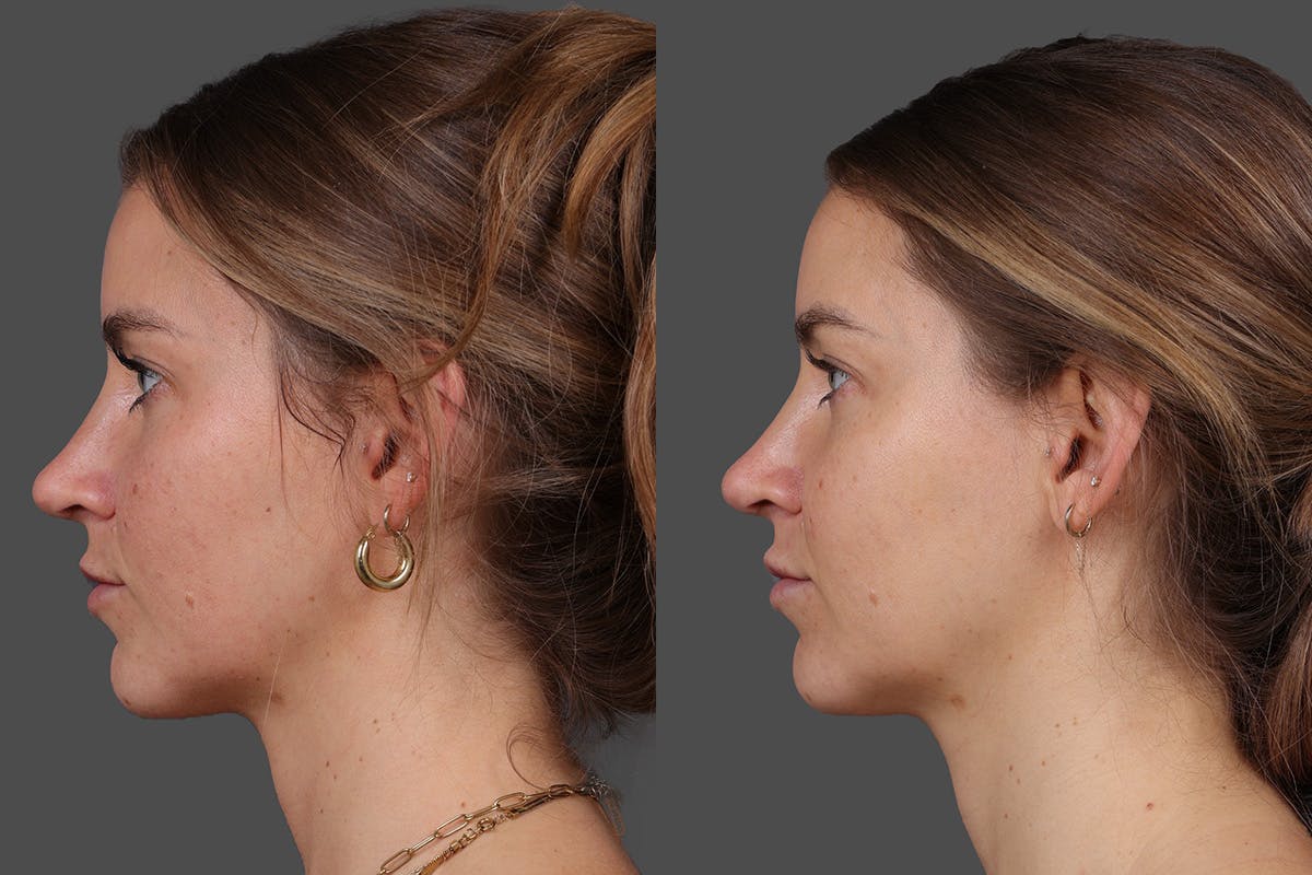 Moxi Before & After Gallery - Patient 530192 - Image 5