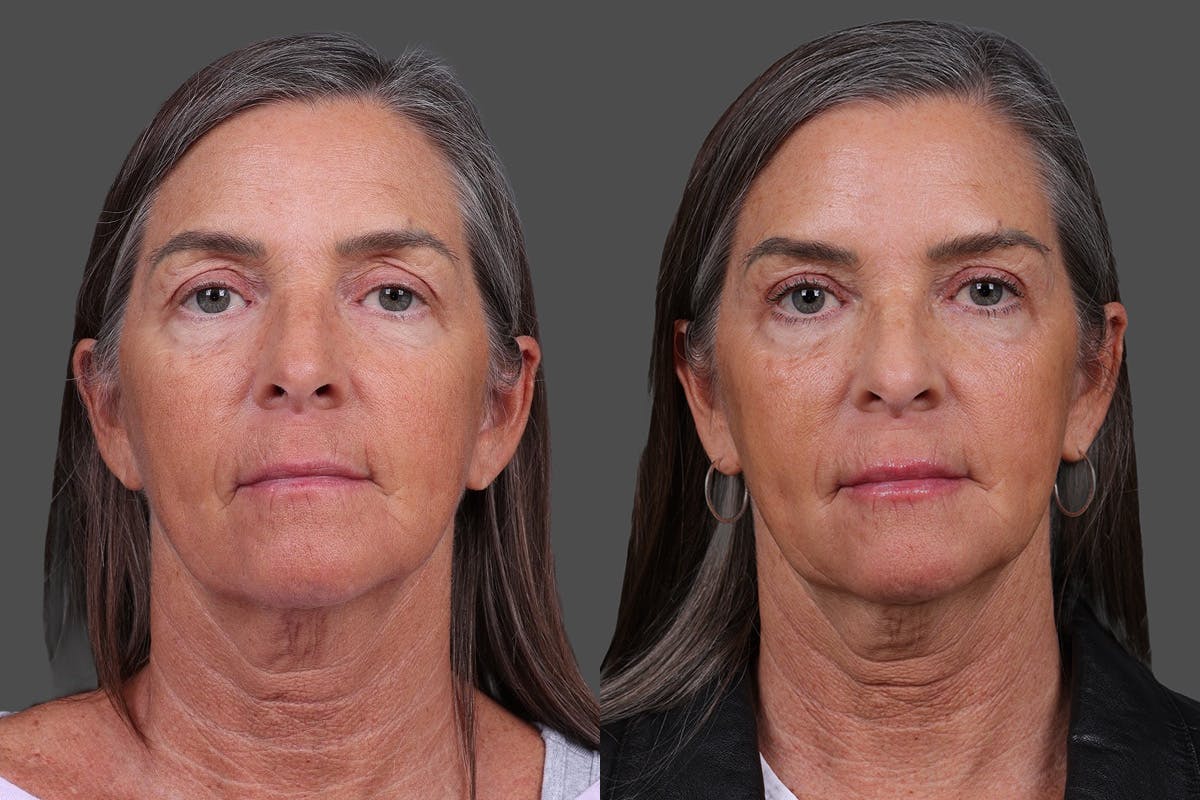 Eyelid Surgery (Blepharoplasty) Before & After Gallery - Patient 411918 - Image 1