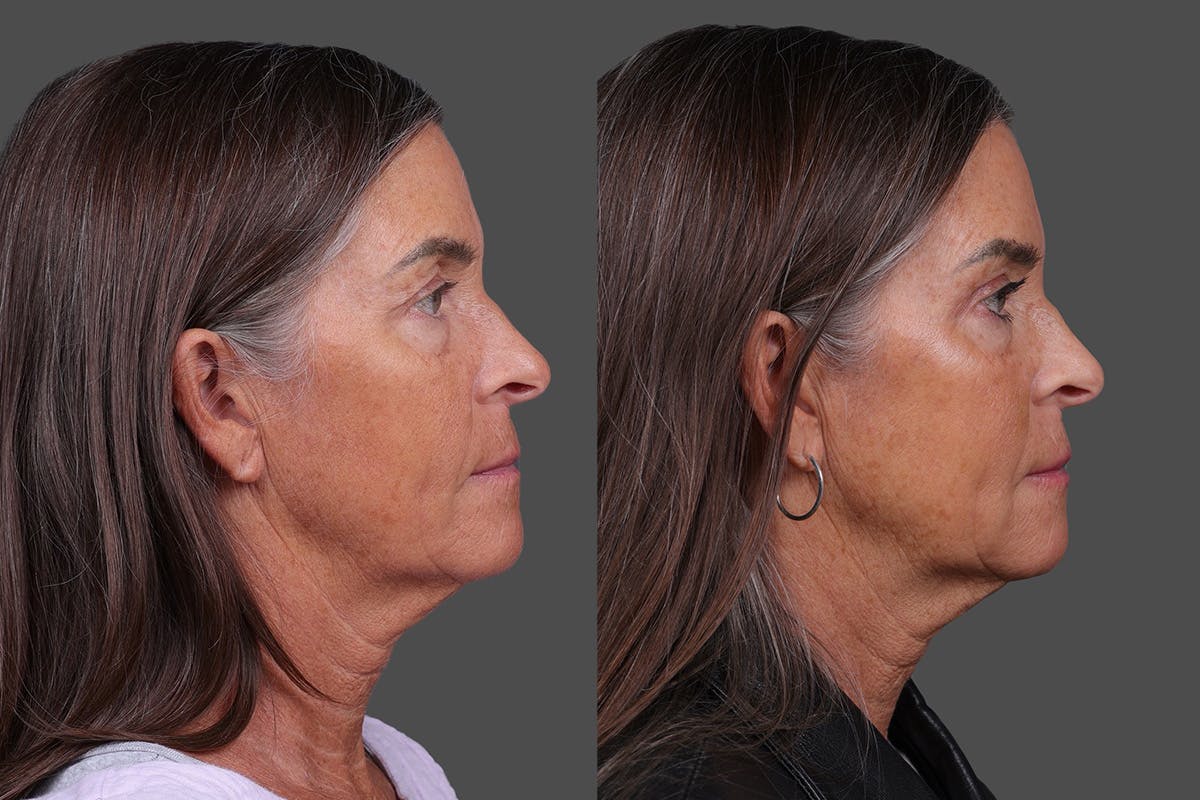 Eyelid Surgery (Blepharoplasty) Before & After Gallery - Patient 411918 - Image 3