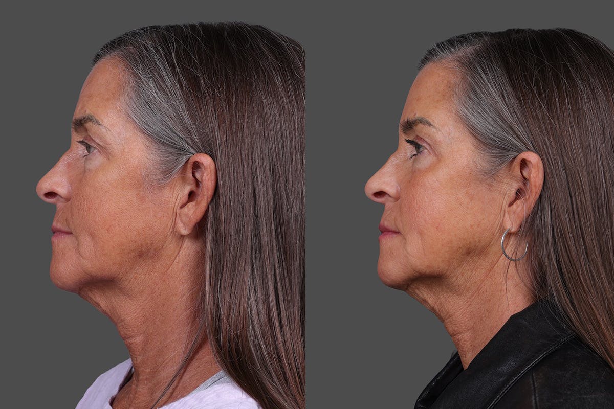 Eyelid Surgery (Blepharoplasty) Before & After Gallery - Patient 411918 - Image 5