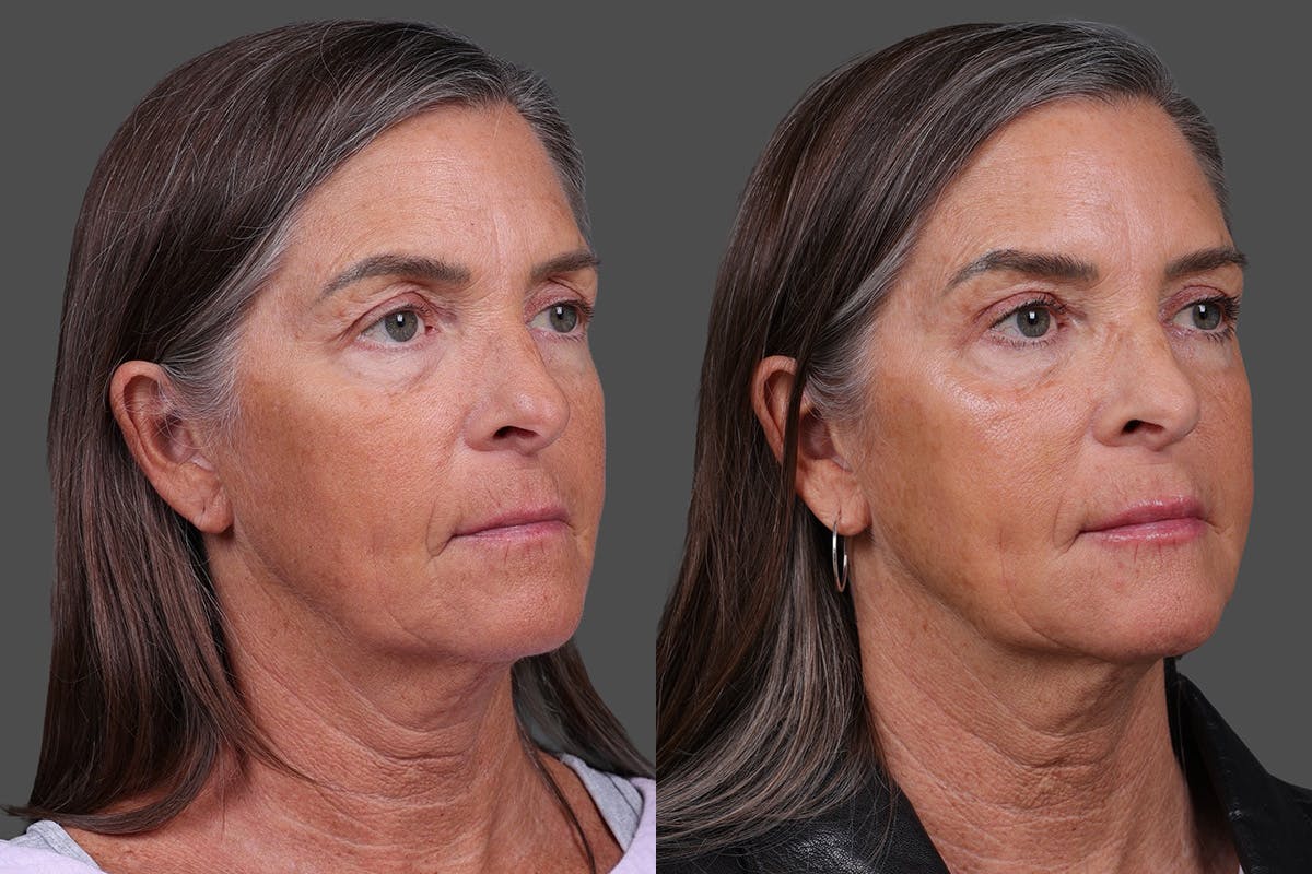 Eyelid Surgery (Blepharoplasty) Before & After Gallery - Patient 411918 - Image 2