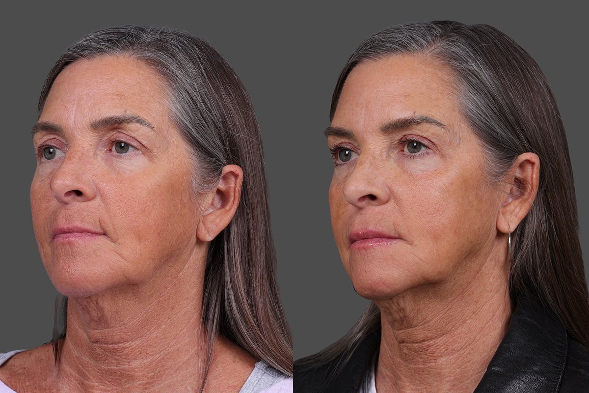 Eyelid Surgery (Blepharoplasty) Before & After Gallery - Patient 411918 - Image 4