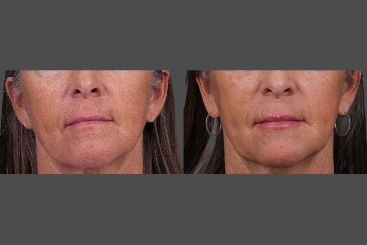 Eyelid Surgery (Blepharoplasty) Before & After Gallery - Patient 411918 - Image 6