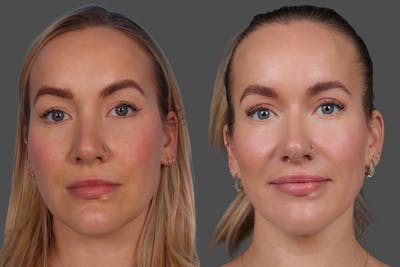 Sculptra Before & After Gallery - Patient 339608 - Image 1