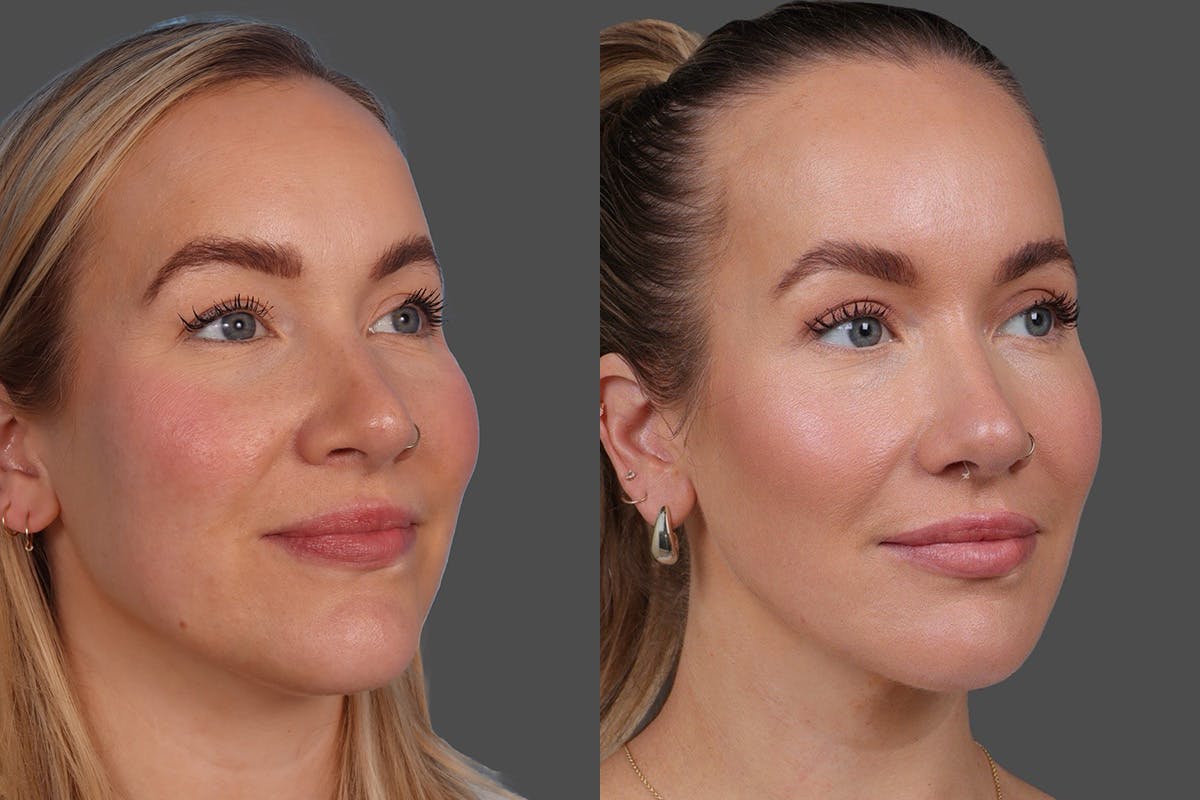 DAXXIFY® Before & After Gallery - Patient 157886 - Image 2