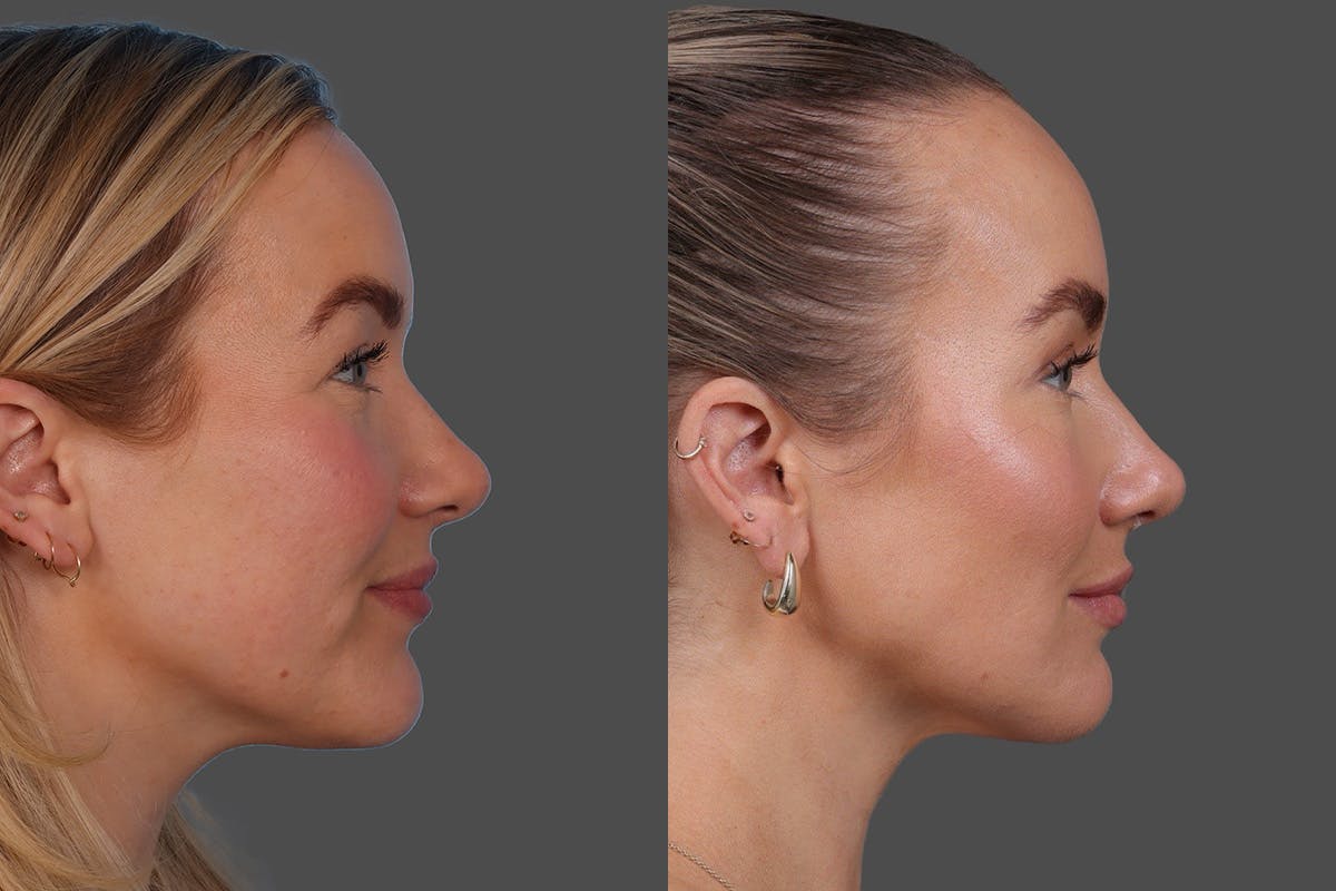 DAXXIFY® Before & After Gallery - Patient 157886 - Image 3