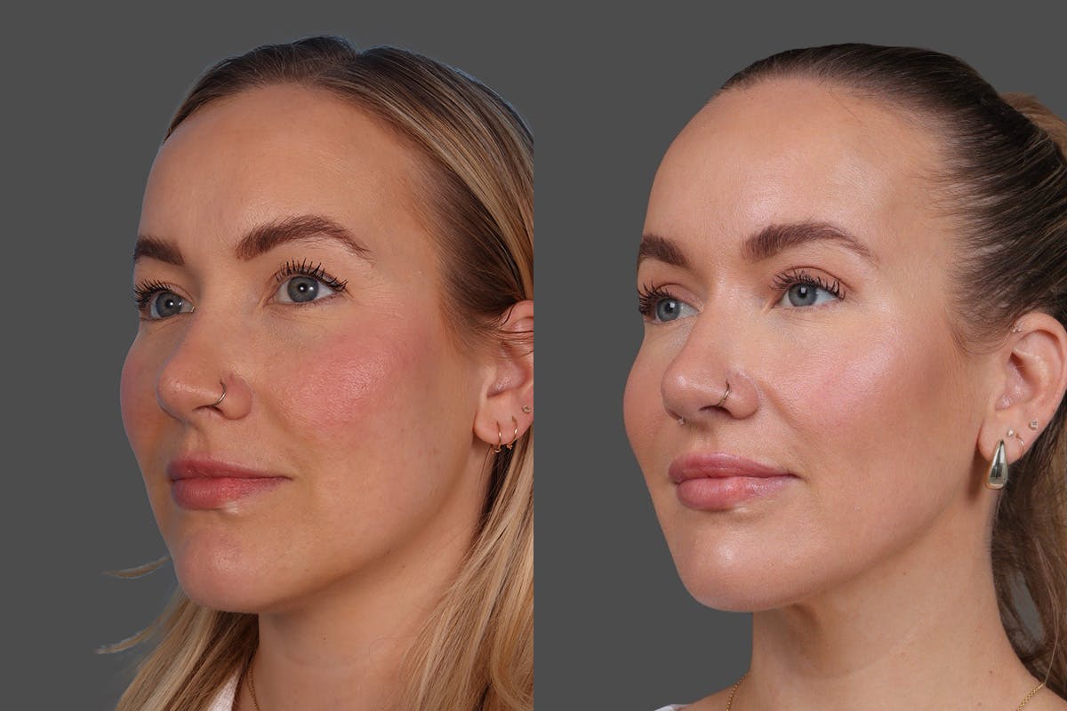 DAXXIFY® Before & After Gallery - Patient 157886 - Image 4
