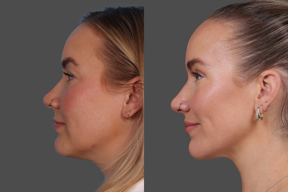 DAXXIFY® Before & After Gallery - Patient 157886 - Image 5