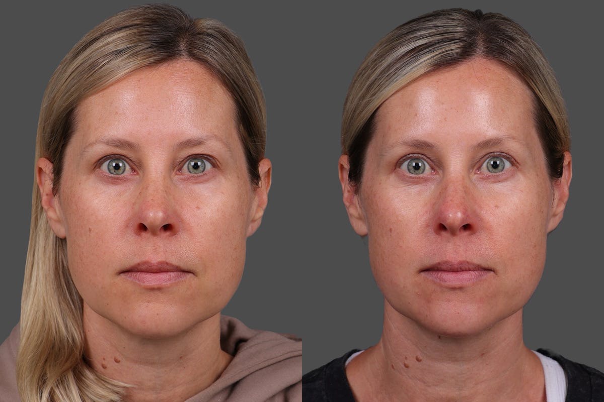 Eyelid Surgery (Blepharoplasty) Before & After Gallery - Patient 118886 - Image 1