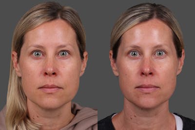 Eyelid Surgery (Blepharoplasty) Before & After Gallery - Patient 118886 - Image 1