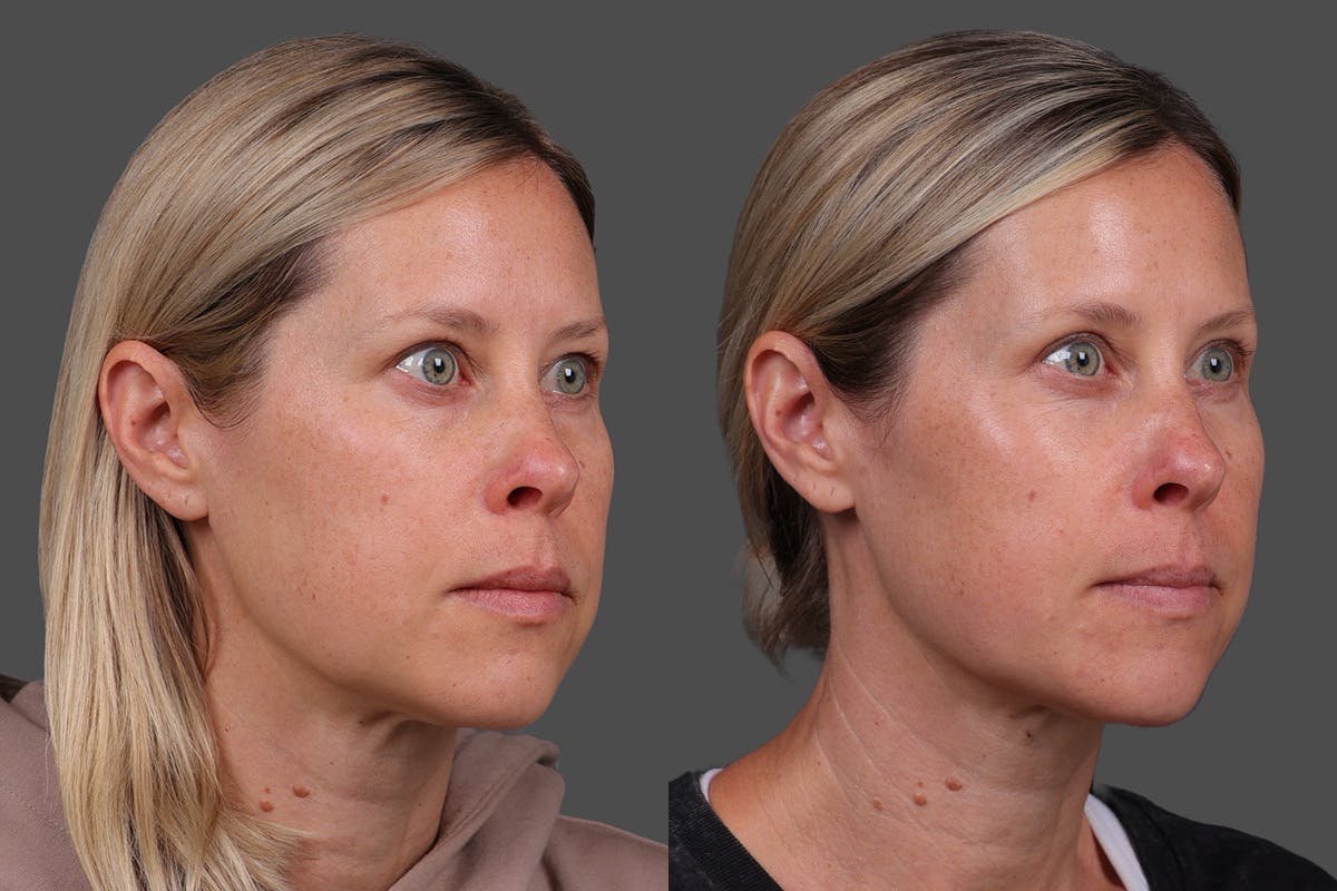 Eyelid Surgery (Blepharoplasty) Before & After Gallery - Patient 118886 - Image 2