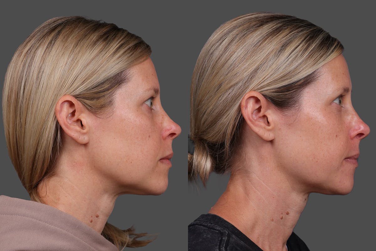 Eyelid Surgery (Blepharoplasty) Before & After Gallery - Patient 118886 - Image 3