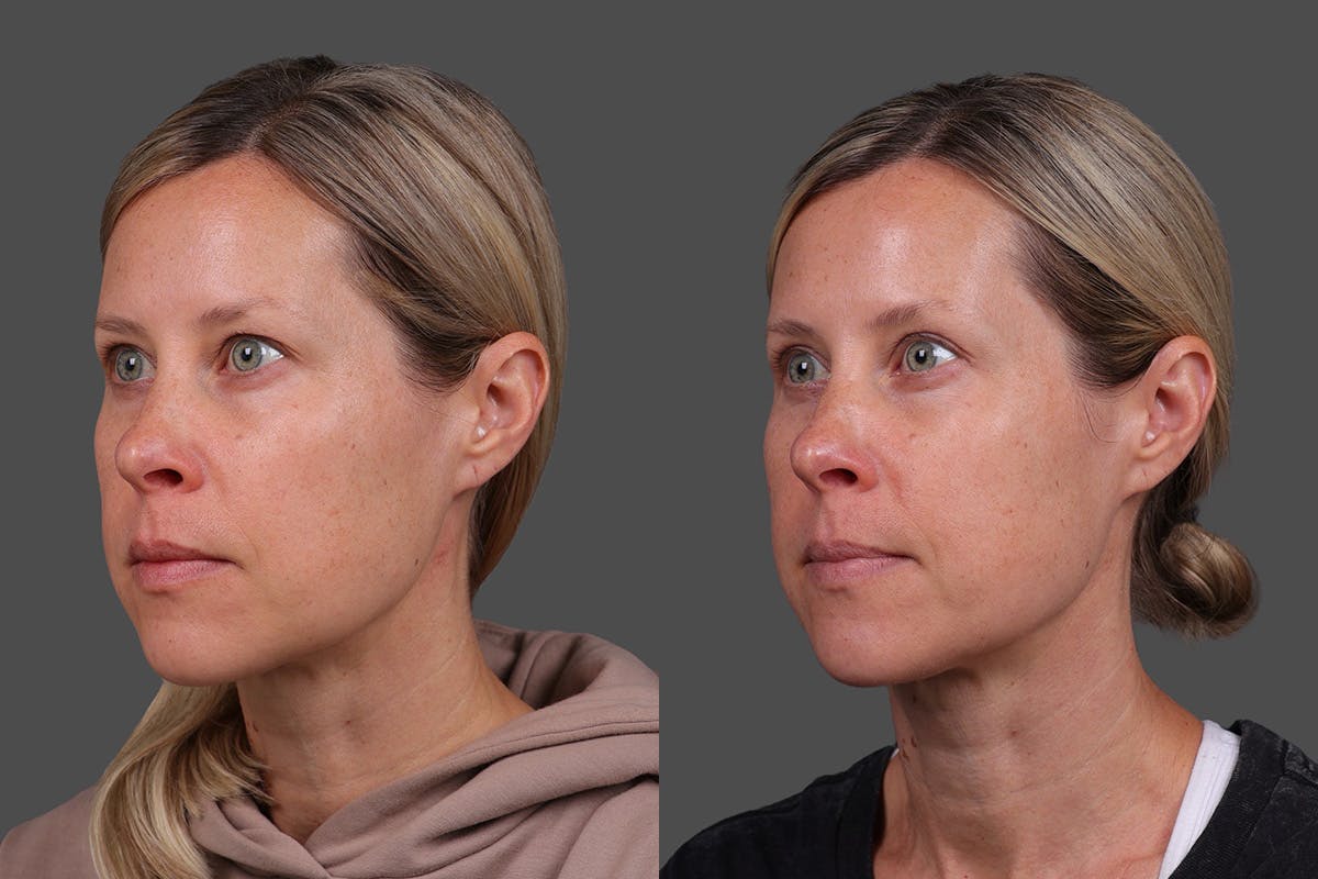 Eyelid Surgery (Blepharoplasty) Before & After Gallery - Patient 118886 - Image 4