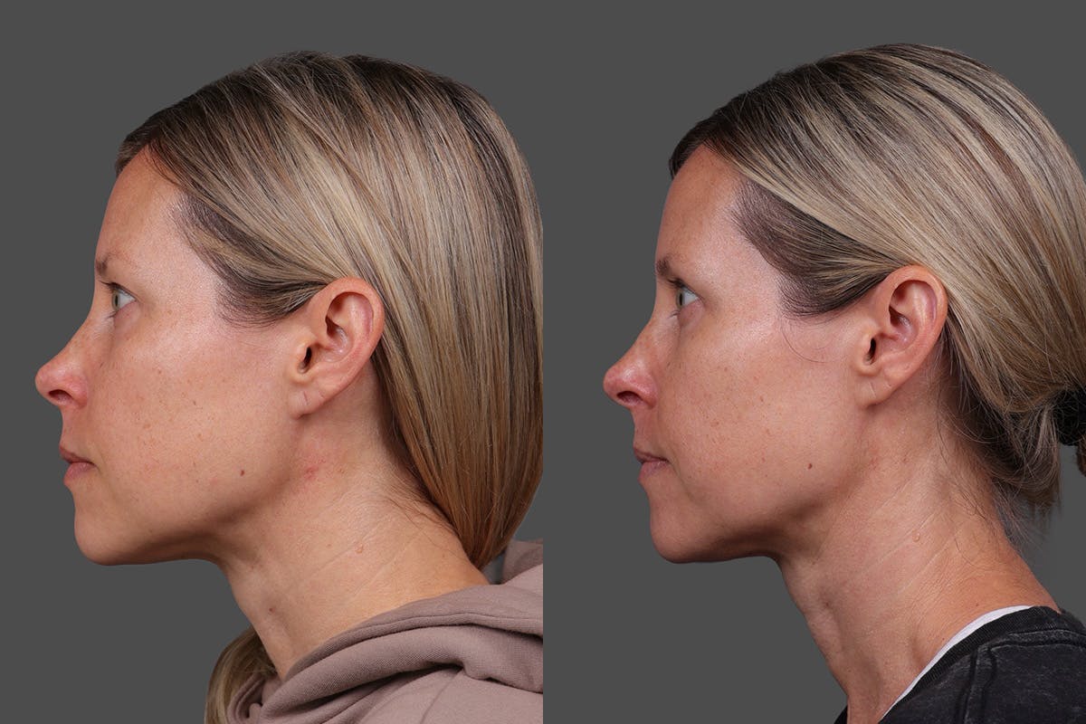 Eyelid Surgery (Blepharoplasty) Before & After Gallery - Patient 118886 - Image 5