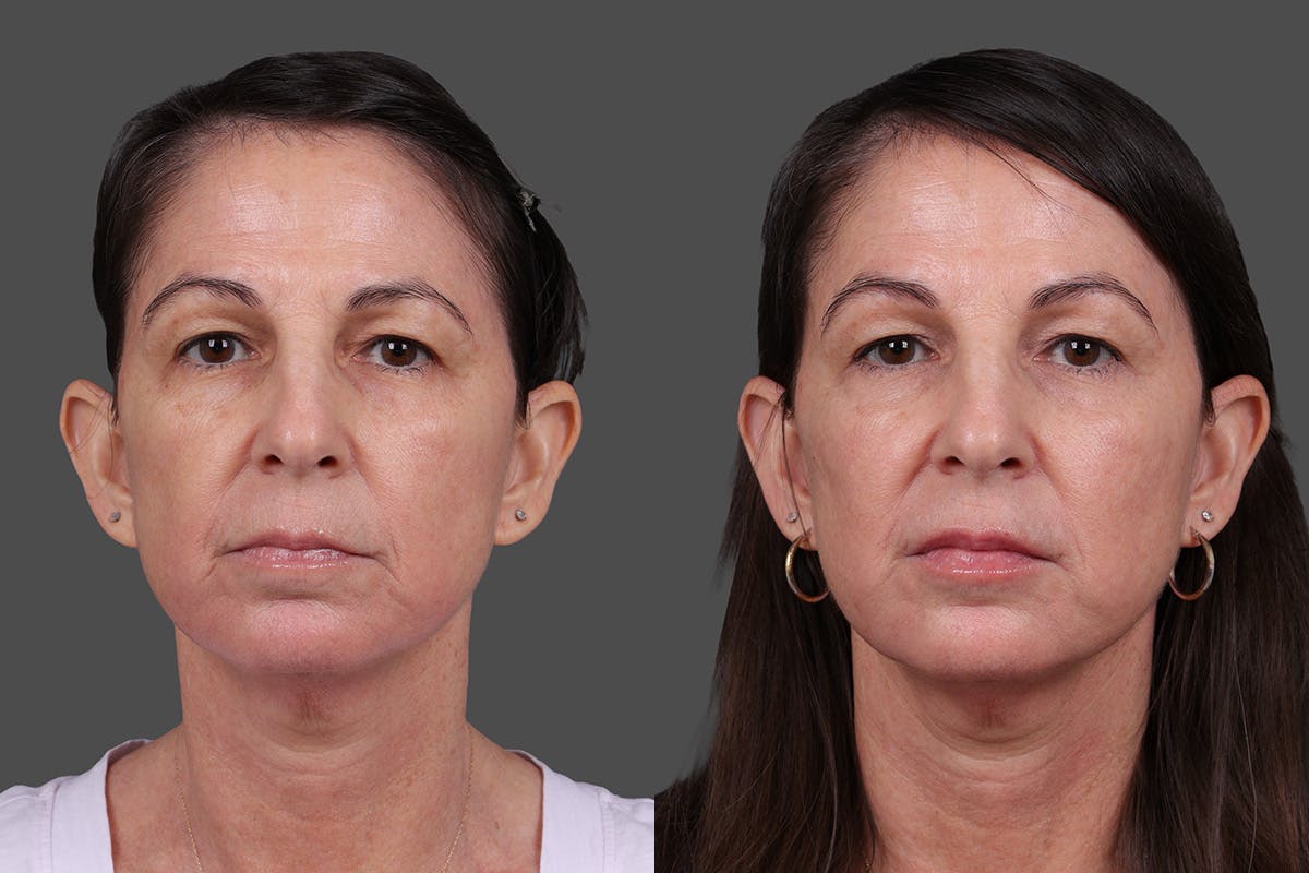 DAXXIFY® Before & After Gallery - Patient 288022 - Image 1