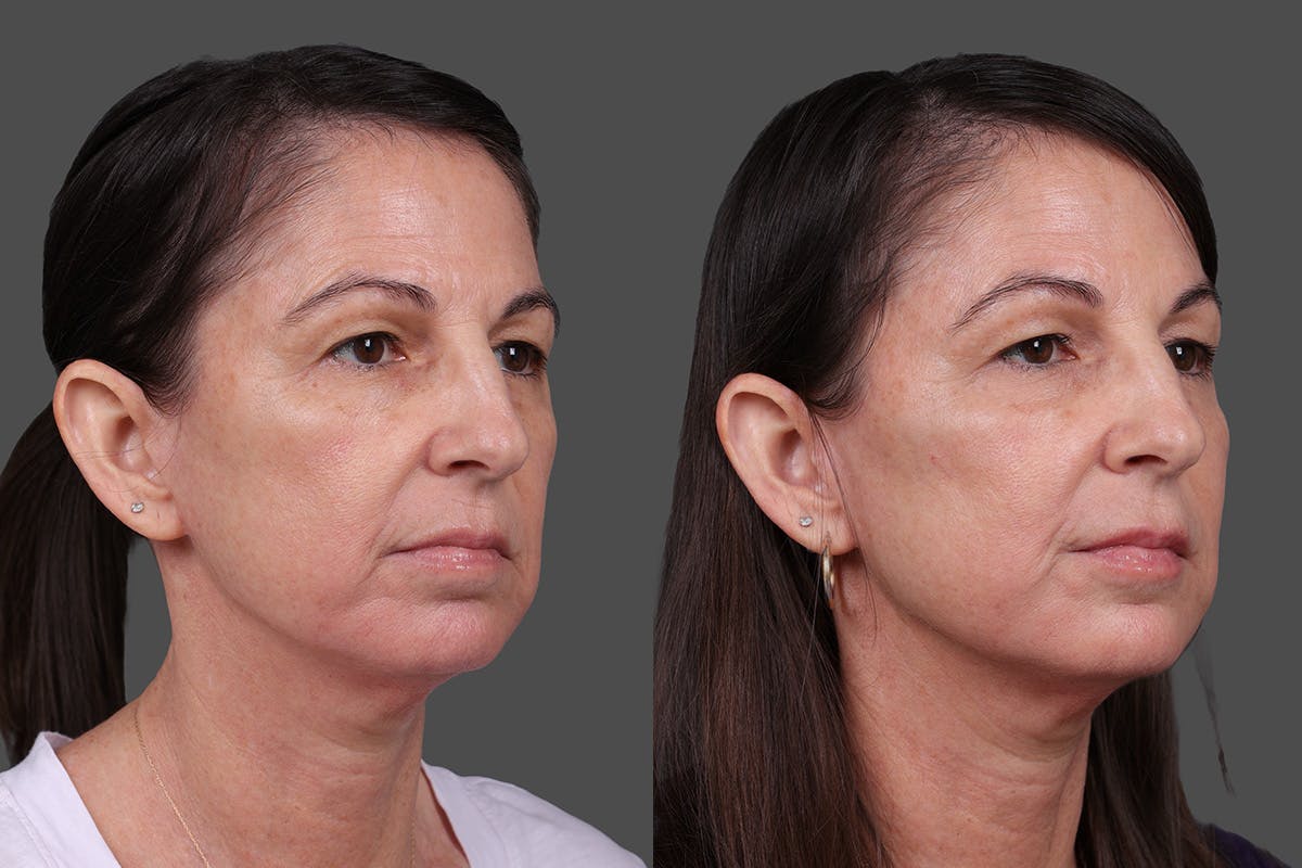 DAXXIFY® Before & After Gallery - Patient 288022 - Image 2