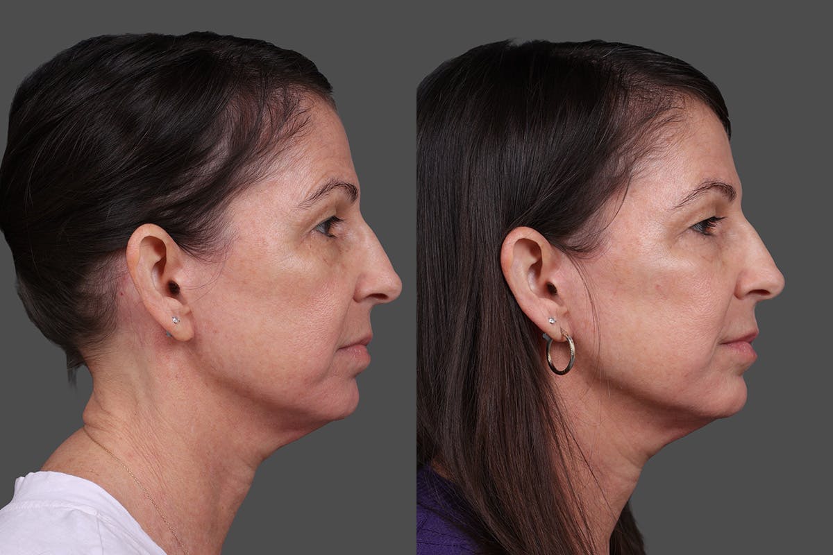 DAXXIFY® Before & After Gallery - Patient 288022 - Image 3