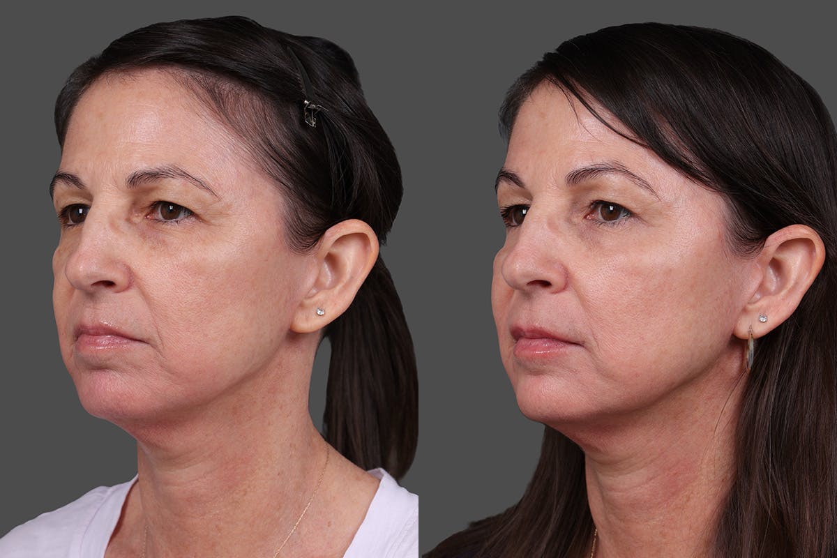 DAXXIFY® Before & After Gallery - Patient 288022 - Image 4