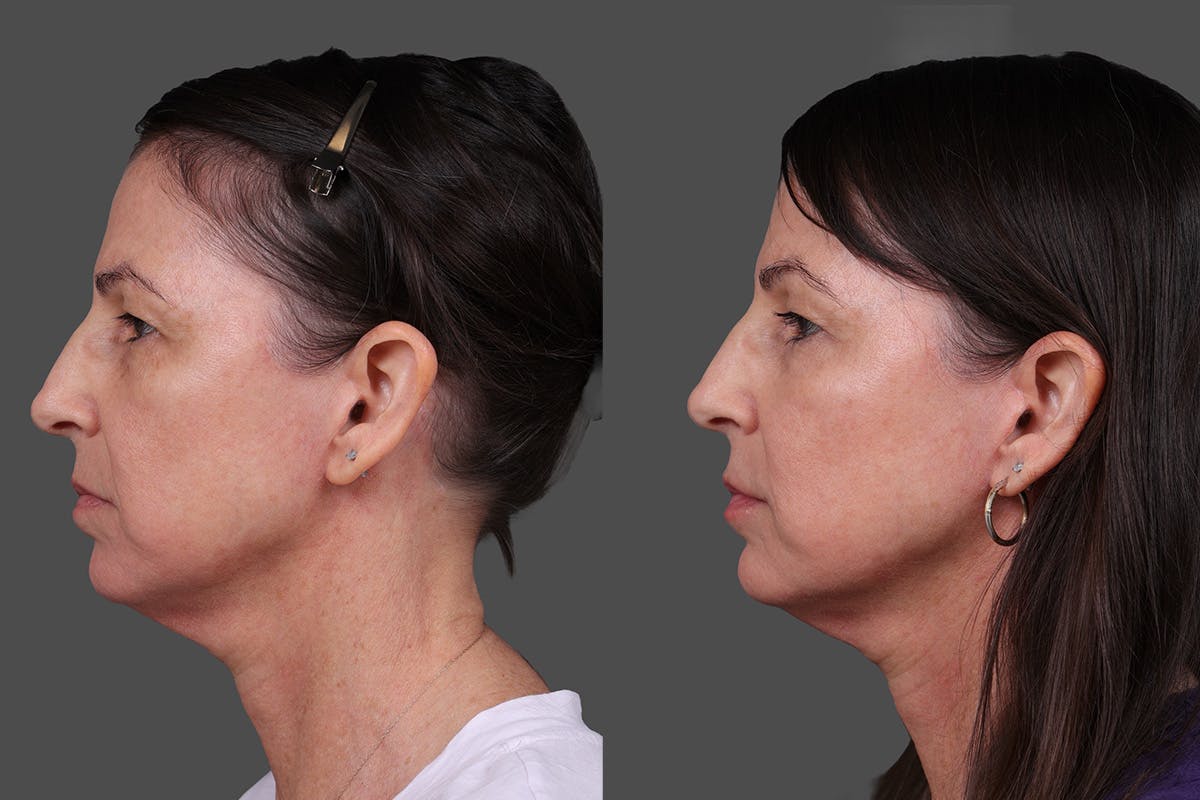 DAXXIFY® Before & After Gallery - Patient 288022 - Image 5