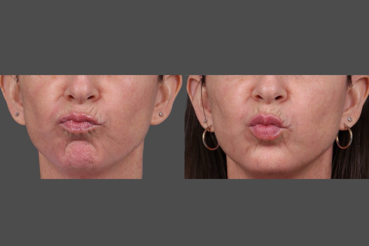 DAXXIFY® Before & After Gallery - Patient 288022 - Image 6