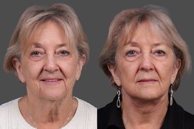 Facelift Before & After Gallery - Patient 777541 - Image 1