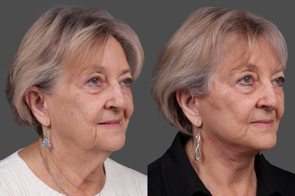 Facelift Before & After Gallery - Patient 777541 - Image 2