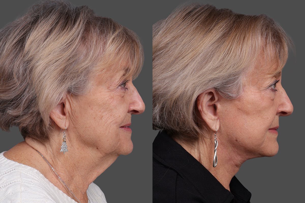 Facelift Before & After Gallery - Patient 777541 - Image 3