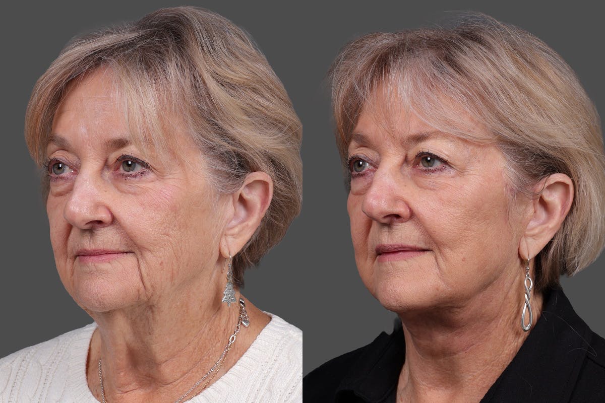 Facelift Before & After Gallery - Patient 777541 - Image 4