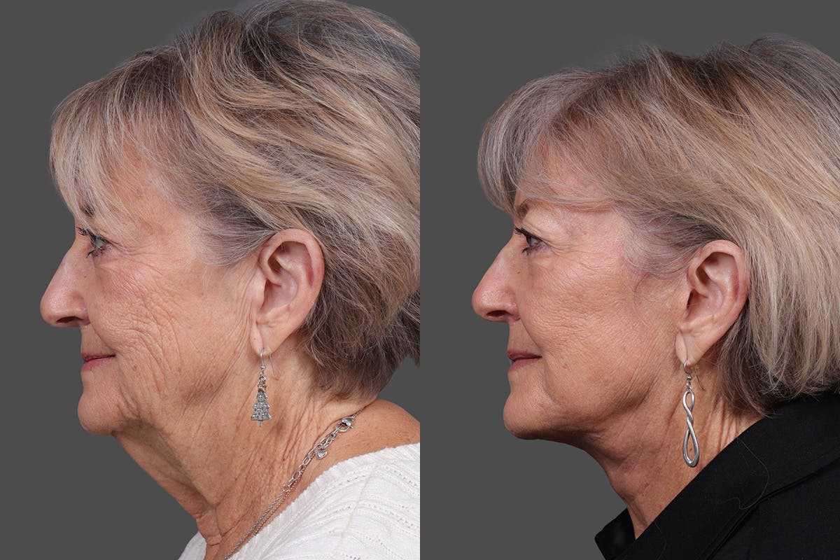 Facelift Before & After Gallery - Patient 777541 - Image 5