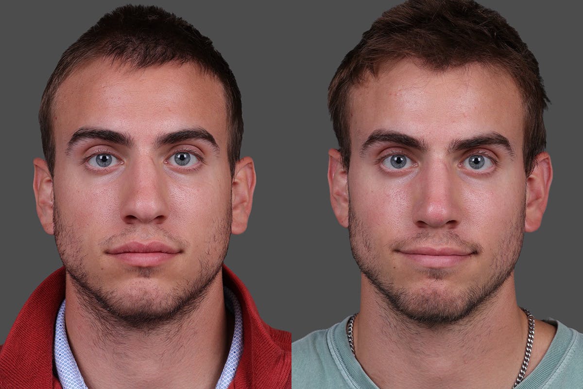 Rhinoplasty Before & After Gallery - Patient 284121 - Image 3