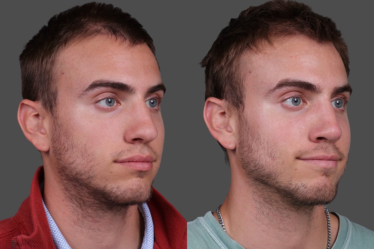 Rhinoplasty Before & After Gallery - Patient 284121 - Image 2