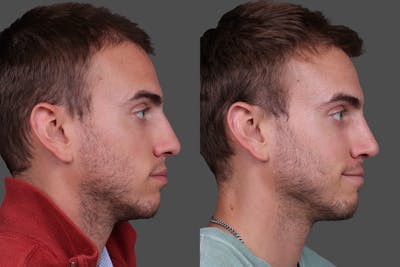 Rhinoplasty Before & After Gallery - Patient 284121 - Image 1