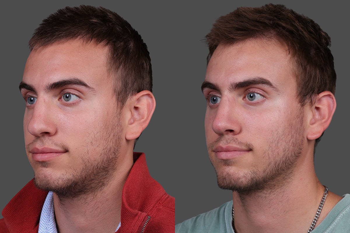 Rhinoplasty Before & After Gallery - Patient 284121 - Image 4
