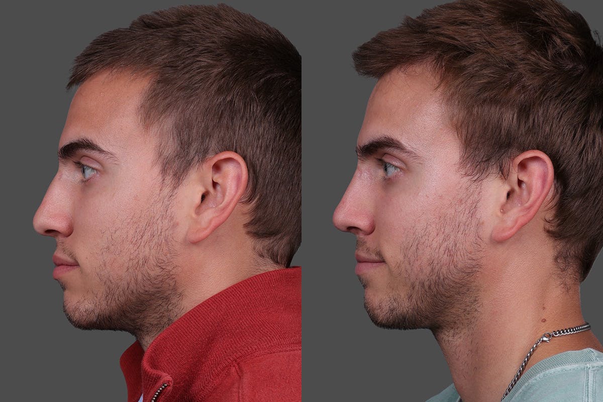 Rhinoplasty Before & After Gallery - Patient 284121 - Image 5