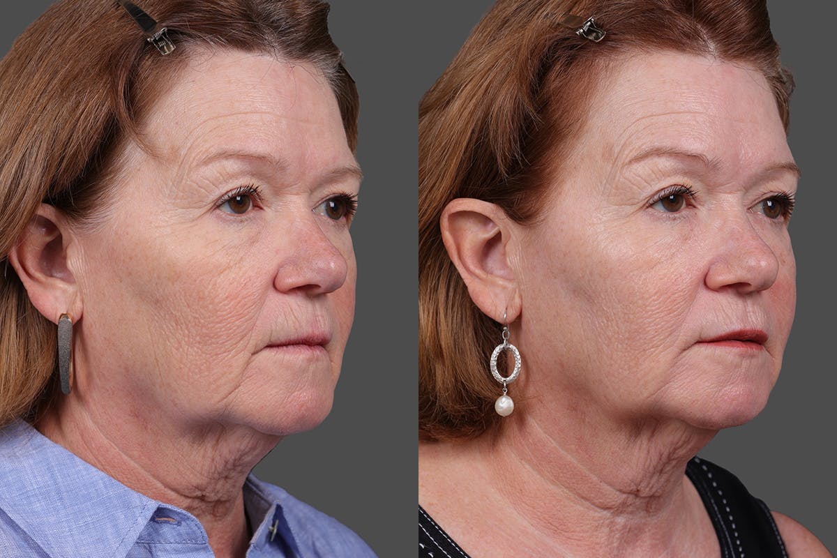 Revance RHA Before & After Gallery - Patient 343583 - Image 2