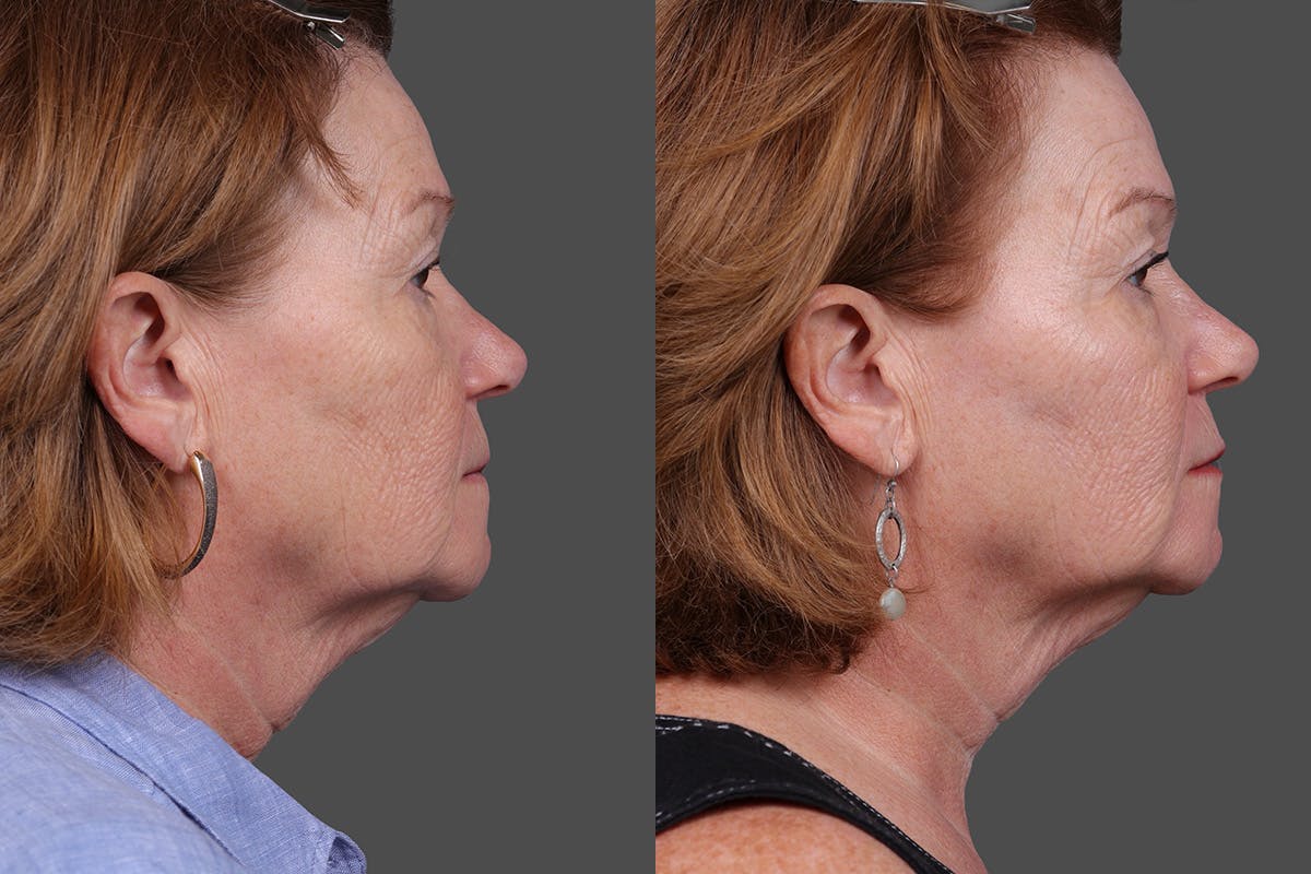 Revance RHA Before & After Gallery - Patient 343583 - Image 3
