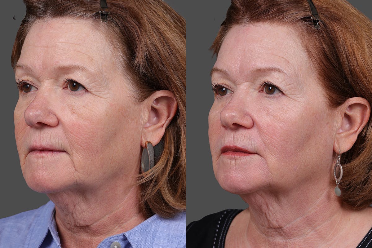 Revance RHA Before & After Gallery - Patient 343583 - Image 4