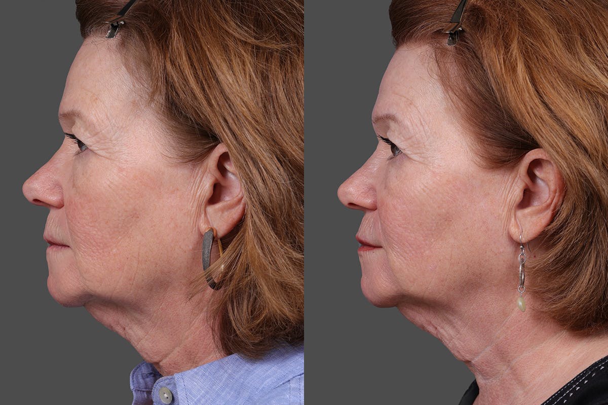 Revance RHA Before & After Gallery - Patient 343583 - Image 5