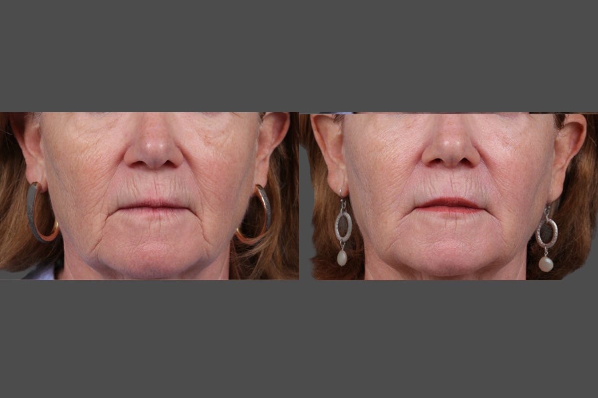 Revance RHA Before & After Gallery - Patient 343583 - Image 6