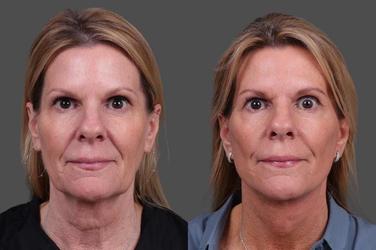 Facelift Before & After Gallery - Patient 310889 - Image 1
