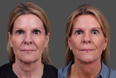 Facelift Before & After Gallery - Patient 310889 - Image 1