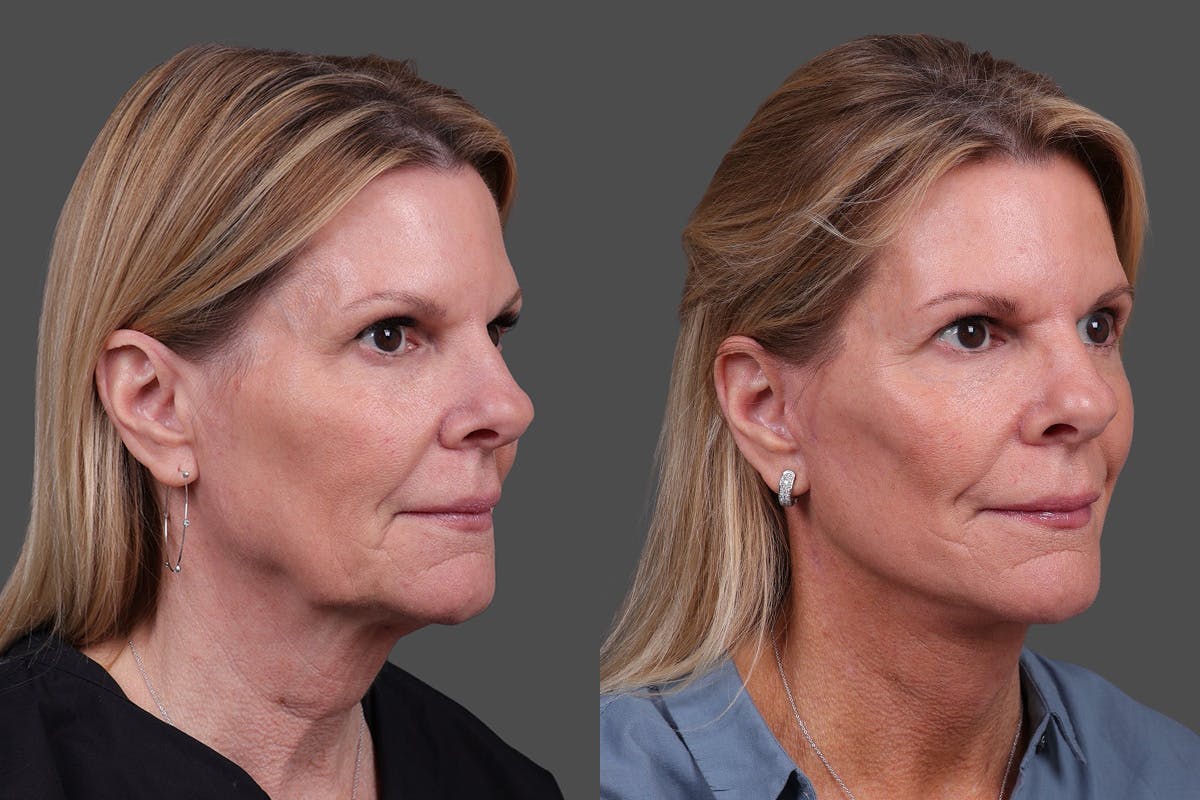 Facelift Before & After Gallery - Patient 310889 - Image 2